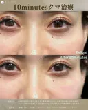10minutesクマ治療 before画像 サムネイル用
