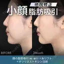 他院修正脂肪吸引（顔2部位）＋糸リフト＋ボツリヌストキシン注射 after画像 サムネイル用