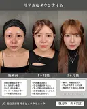 🎀完全保存版🎀小顔整形のダウンタイムを公開📸 before画像 サムネイル用