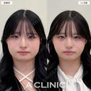 【1day小顔＋小顔エラボトックス】下膨れ顔解消しました！こちら処置前と1ヶ月後の症例です 30日後 サムネイル用