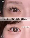 韓流目頭切開 30日後 サムネイル用