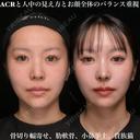 ACRと人中の見え方とお顔全体のバランス重視 before画像 サムネイル用