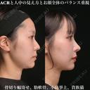 ACRと人中の見え方とお顔全体のバランス重視 90日後 サムネイル用