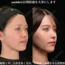 ゼティスは長期経過を大事にします。 365日後 サムネイル用