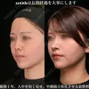 ゼティスは長期経過を大事にします。 365日後 サムネイル用