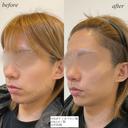 顎ほうれい線ヒアルロン酸 after画像 サムネイル用