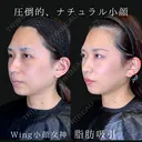 Wing小顔女神脂肪吸引 90日後 サムネイル用