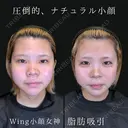 Wing小顔女神脂肪吸引 before画像 サムネイル用