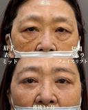 表ハムラ＋ミッドフェイスリフト、眉下切開 before画像 サムネイル用