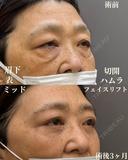 表ハムラ＋ミッドフェイスリフト、眉下切開 90日後 サムネイル用