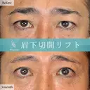 Wing式眉下リフト before画像 サムネイル用