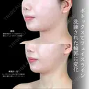 エラボトックス/顎ボトックス 唇ヒアルロン酸/顎ヒアルロン酸 before画像 サムネイル用