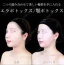 エラボトックス/顎ボトックス 唇ヒアルロン酸/顎ヒアルロン酸 90日後 サムネイル用