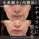 小鼻縮小（内側法） before画像 サムネイル用