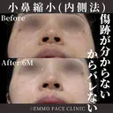 小鼻縮小（内側法） 180日後 サムネイル用