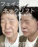 フェイスリフト・ネックリフト before画像 サムネイル用