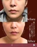 スレッド（糸）リフト before画像 サムネイル用