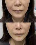 ヒアルロン酸 after画像 サムネイル用