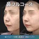 鼻フルコース（鼻複合自家組織移植術）＋鼻プロテーゼ挿入隆鼻術＋貴族フィラー（鼻翼基部ヒアルロン酸注入術） after画像 サムネイル用