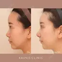 鼻中隔延長、隆鼻、鼻柱下降、鼻翼縮小（内側） before画像 サムネイル用
