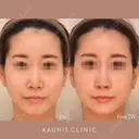 鼻中隔延長、隆鼻、鼻柱下降、鼻翼縮小（内側） after画像 サムネイル用