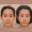 鼻中隔延長、隆鼻、鼻柱下降、鼻翼縮小（内側） after画像 サムネイル用