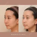 鼻中隔延長、隆鼻、鼻柱下降、鼻翼縮小（内側） after画像 サムネイル用