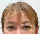 眉下リフト before画像 サムネイル用