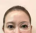 眉下リフト 31日後 サムネイル用