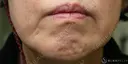 【70代女性・左マリオネットラインの長期経過】プレミアムPRP皮膚再生療法（6年後） before画像 サムネイル用