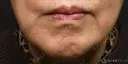 【70代女性・左マリオネットラインの長期経過】プレミアムPRP皮膚再生療法（6年後） 2190日後 サムネイル用