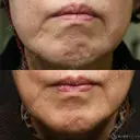 【70代女性・左マリオネットラインの長期経過】プレミアムPRP皮膚再生療法（6年後） 2190日後 サムネイル用