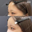 額ヒアルロン酸 before画像 サムネイル用