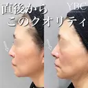 【直後からこのクオリティ鼻整形👃✨】 after画像 サムネイル用