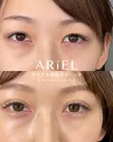 アリエルクイックループ（二重埋没法） before画像 サムネイル用