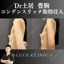 コンデンスリッチ脂肪豊胸 before画像 サムネイル用