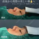 10分でバレにくく理想の鼻に✨ before画像 サムネイル用