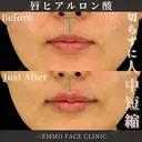ヒアルロン酸（唇） before画像 サムネイル用