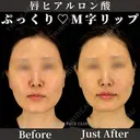 ヒアルロン酸（唇） 0日後 サムネイル用