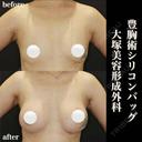 豊胸術シリコンバッグ after画像 サムネイル用