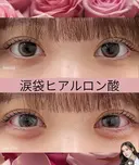 ヒアルロン酸（涙袋） after画像 サムネイル用