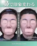 プロテーゼ、鼻尖形成、軟骨移植 before画像 サムネイル用