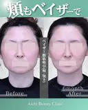 ベイザー脂肪吸引【頬・顎】 after画像 サムネイル用