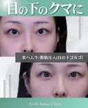 裏ハムラ、脂肪注入 before画像 サムネイル用