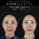 【王式切開リフト　術後3年3ヶ月】 before画像 サムネイル用
