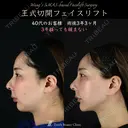 【王式切開リフト　術後3年3ヶ月】 1185日後 サムネイル用