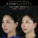 【王式切開リフト　術後3年3ヶ月】 1185日後 サムネイル用