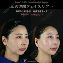 【王式切開リフト　術後3年3ヶ月】 1185日後 サムネイル用