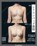 シリコンバック豊胸 before画像 サムネイル用