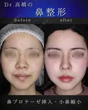 小鼻縮小(切開) before画像 サムネイル用